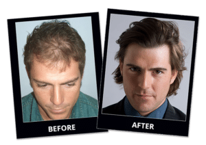 AlviArmani Beverly Hills Hair Transplant Clinic