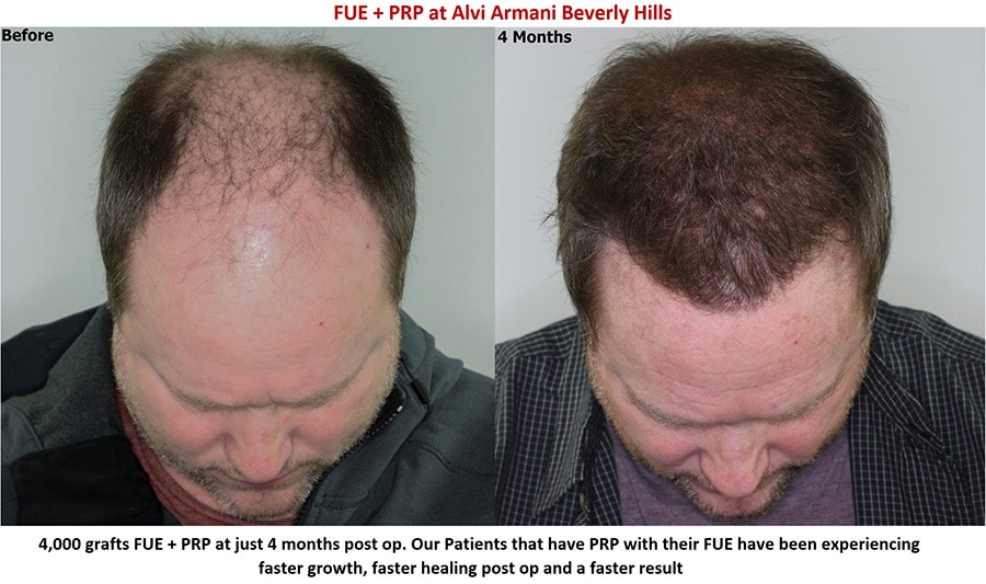 Patients are seeing faster results with PRP in combination with their Hair  Restoration procedure - AlviArmani - Hair Transplant Los Angeles
