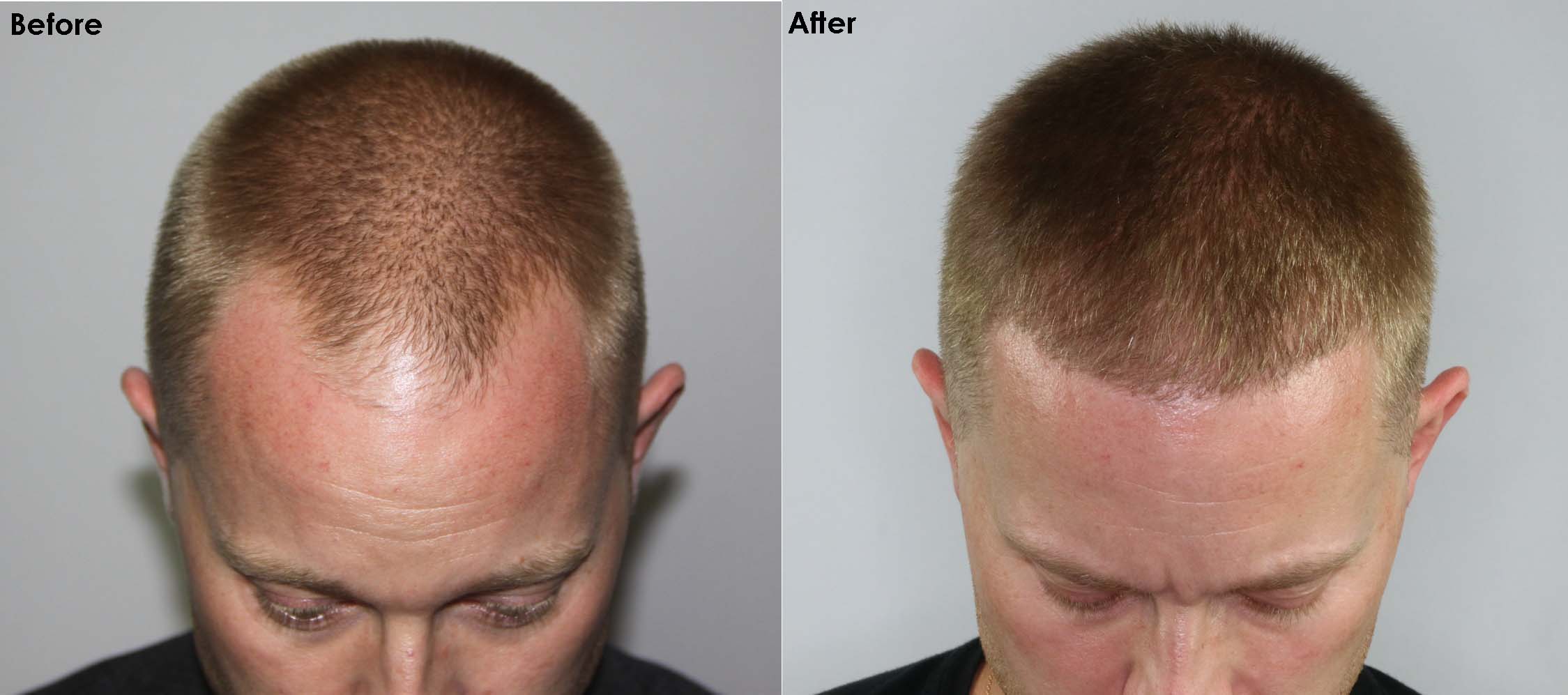Case Study - Can I Wear My Hair Short After A Hair Transplant? - AlviArmani  - Hair Transplant Los Angeles