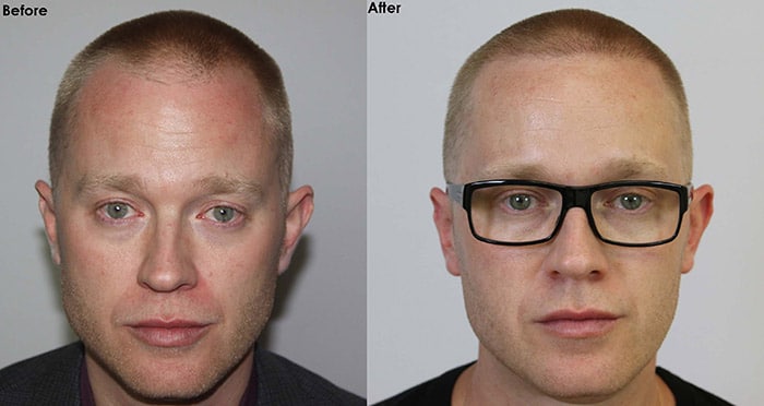 AlviArmani Artistic Hair Transplants - Beverly Hills | Los Angeles | FUE Hair Restoration AlviArmani Artistic Hair Transplants - Beverly Hills | Los Angeles | FUE Hair Restoration