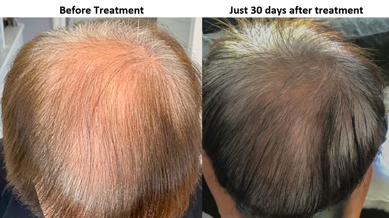 Exosome treatment for hair loss - Results at just 40 days - AlviArmani -  Hair Transplant Los Angeles