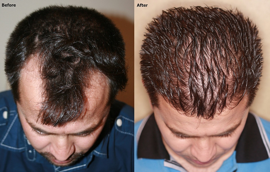 FUE Hair Restoration For Temple Recession - AlviArmani - Hair Transplant  Los Angeles