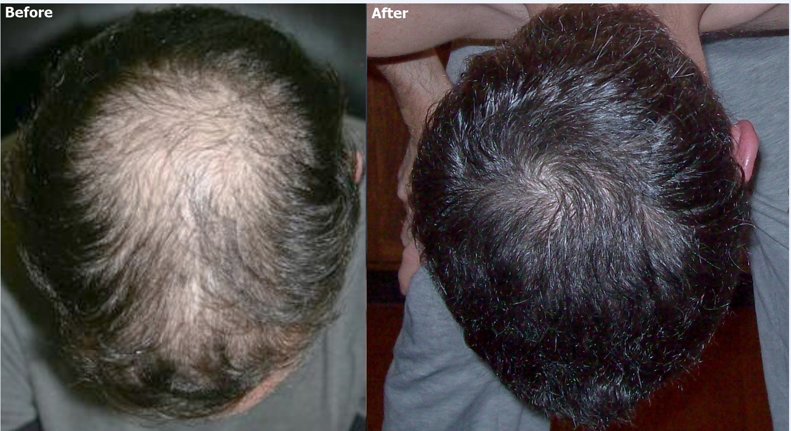 Crown Hair Restoration - AlviArmani - Hair Transplant Los Angeles