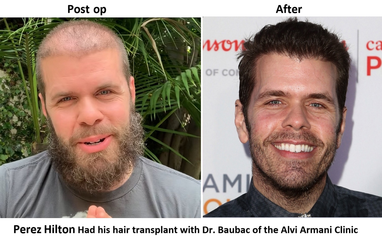 what do celebrities do for hair loss