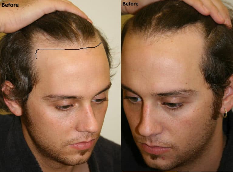 Hairline Restoration Case Study Alvi Armani Hair Transplant Los Angeles