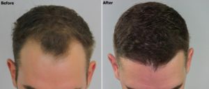 Before and After FUE + PRP
