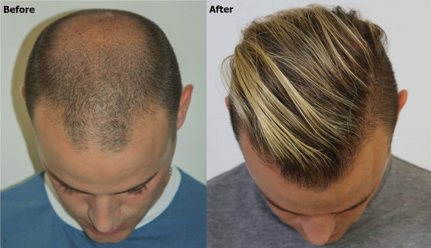 4. Blonde Hair Transplant Results - wide 5