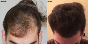 Before After Hair Transplant With PRP 3500 grafts FUE