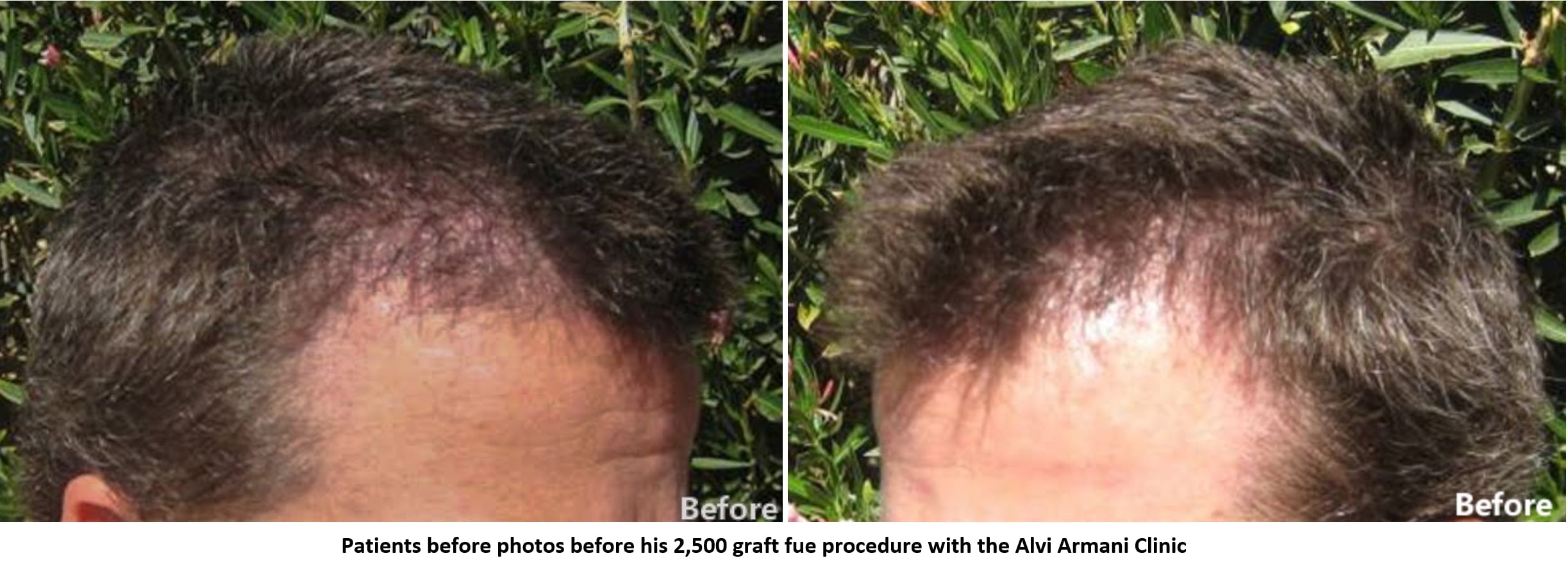 2,500 Graft FUE Result – After Photos with Wet Hair - AlviArmani - Hair  Transplant Los Angeles