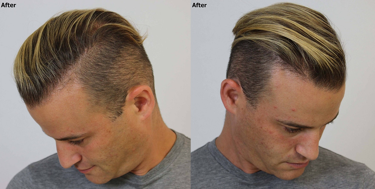 Hairline and Crown hair restoration - AlviArmani - Hair Transplant Los  Angeles