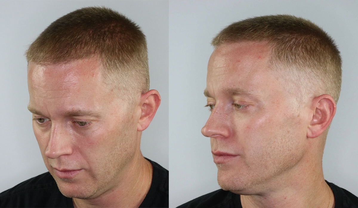 Short Hair Hairline Hair Transplant - AlviArmani - Hair Transplant Los Angeles Short Hair Hairline Hair Transplant - AlviArmani - Hair Transplant Los Angeles