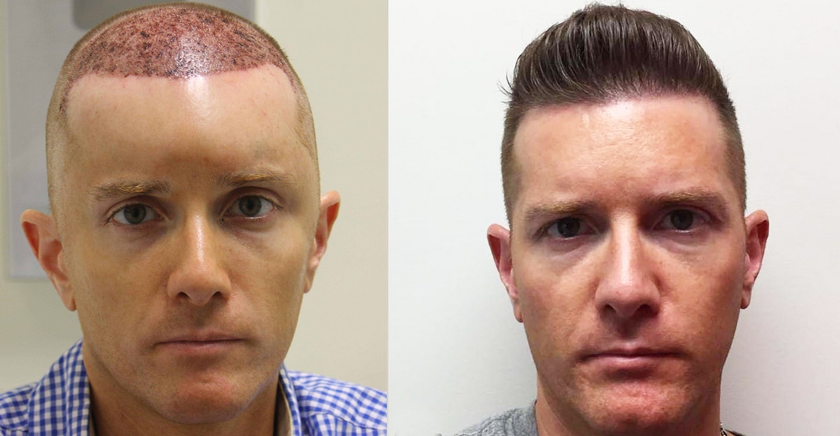Norwood Hair Loss Class 4 - Full Hairline - Hair Transplant Result - AlviArmani - Hair Transplant Los Angeles Norwood Hair Loss Class 4 - Full Hairline - Hair Transplant Result - AlviArmani - Hair Transplant Los Angeles