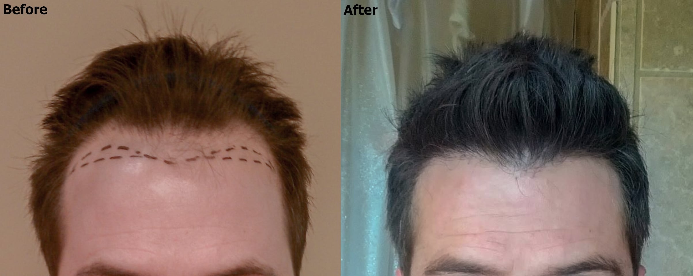 Hairline Lowering + Temple Recession Enhancement - AlviArmani - Hair  Transplant Los Angeles