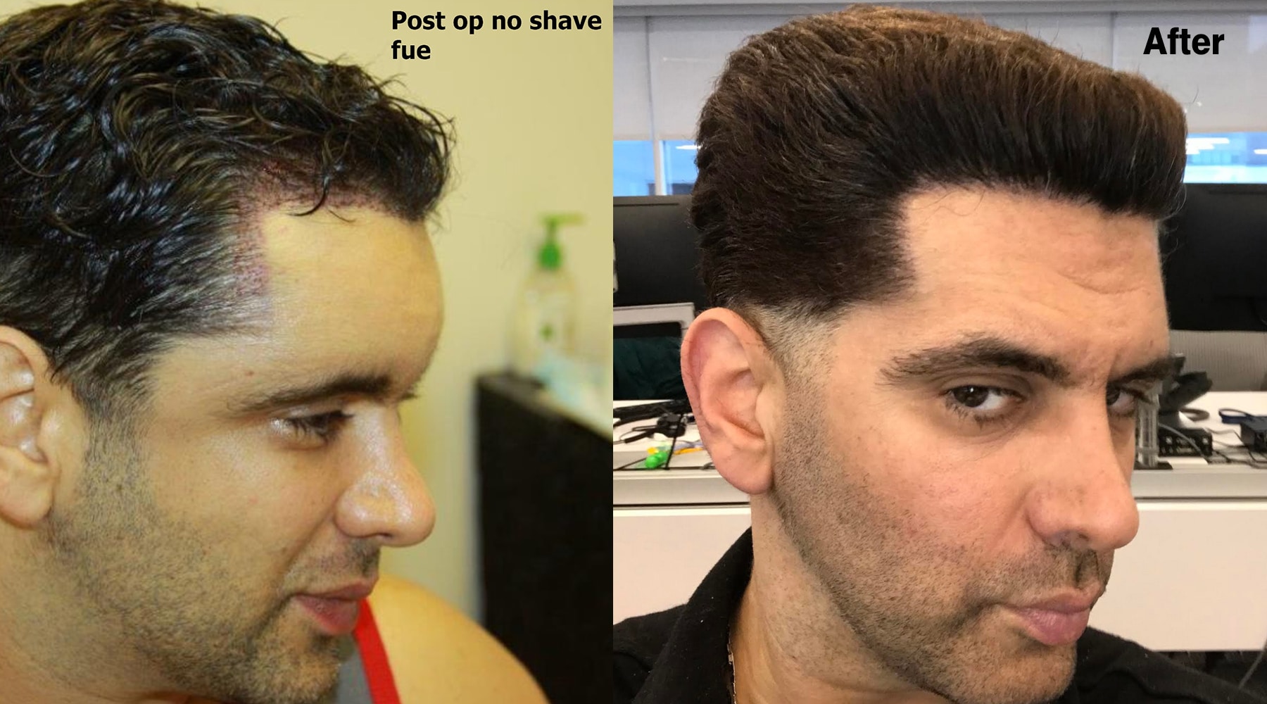 No-shave FUE Hair Transplant – 1,500 Grafts - AlviArmani - Hair Transplant  Los Angeles