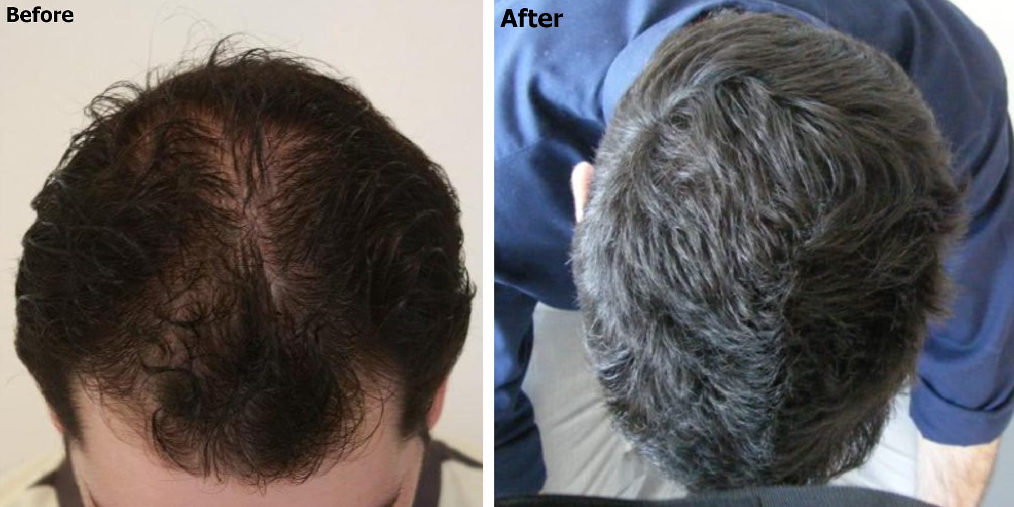 Diffuse Hair Loss Alopecia Causes Signs And Treatments