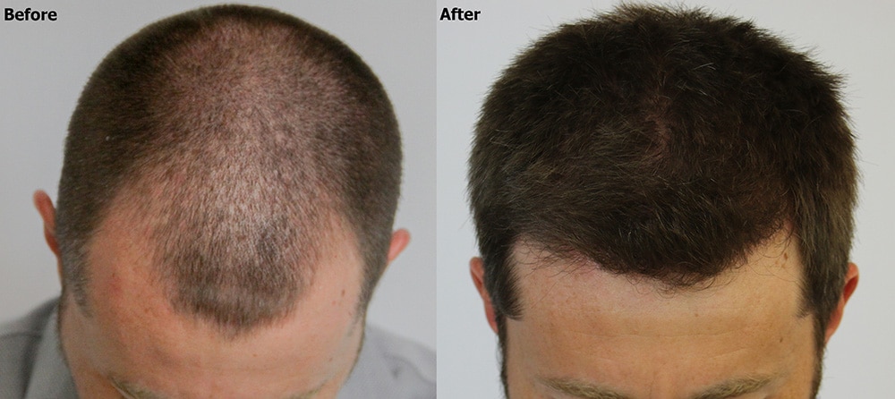 3,000 graft FUE Hair Restoration - AlviArmani - Hair Transplant Los Angeles