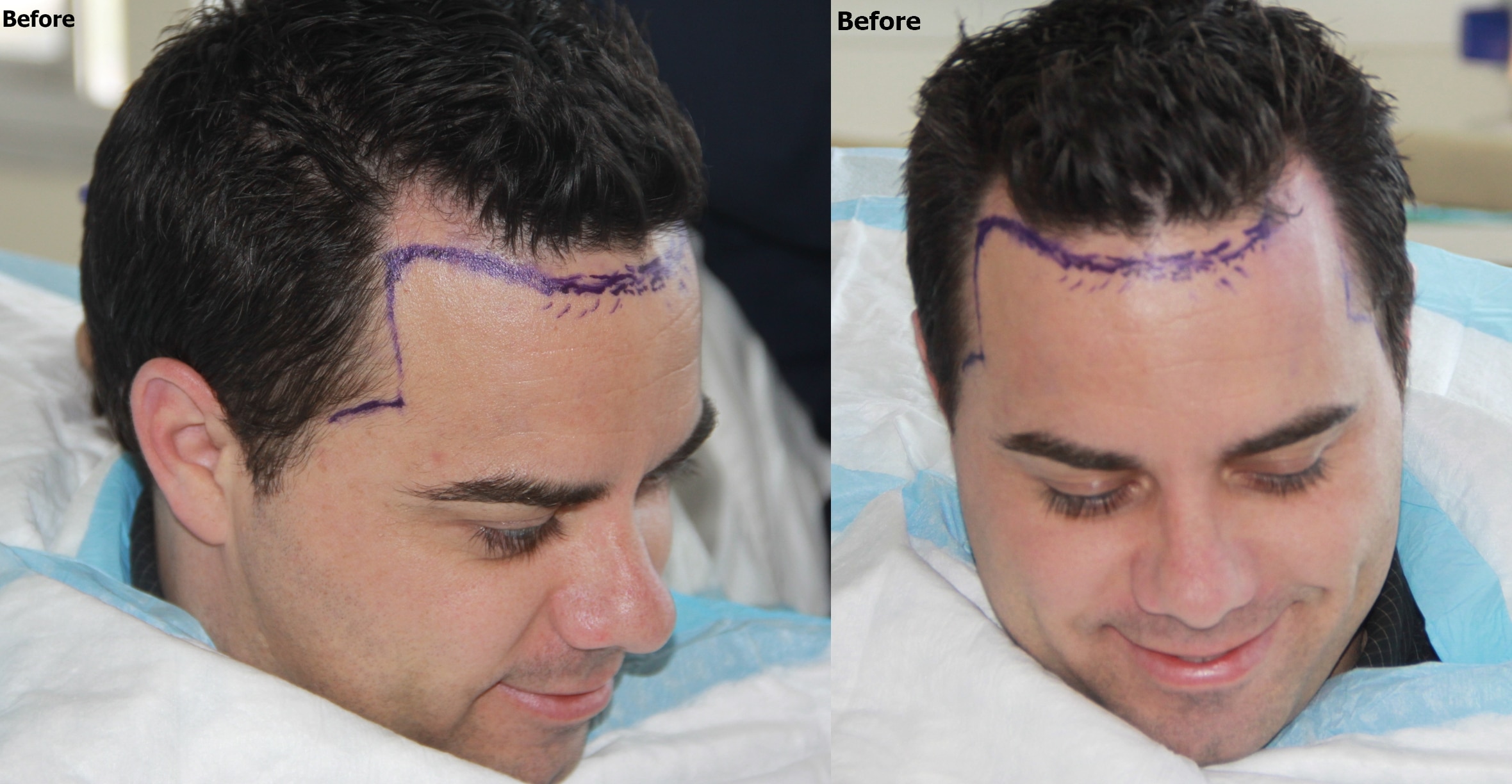 Hairline lowering and Temple closure Hair Restoration - AlviArmani - Hair  Transplant Los Angeles