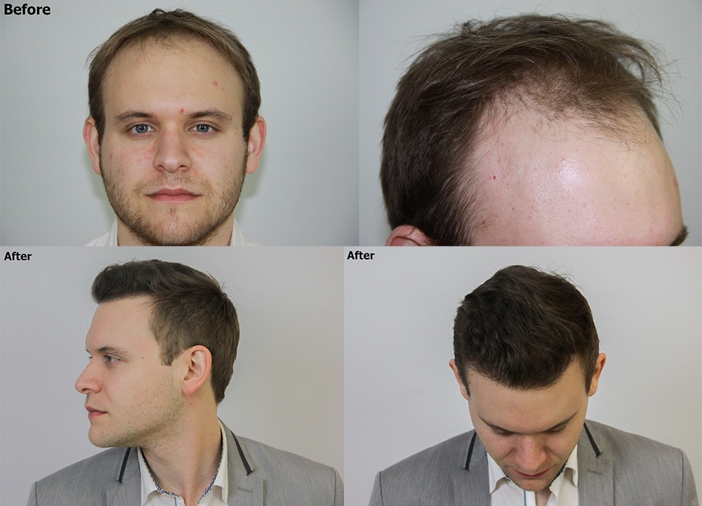 Frontal Region Hair Restoration - 3500 FUE Grafts - AlviArmani - Hair  Transplant Los Angeles