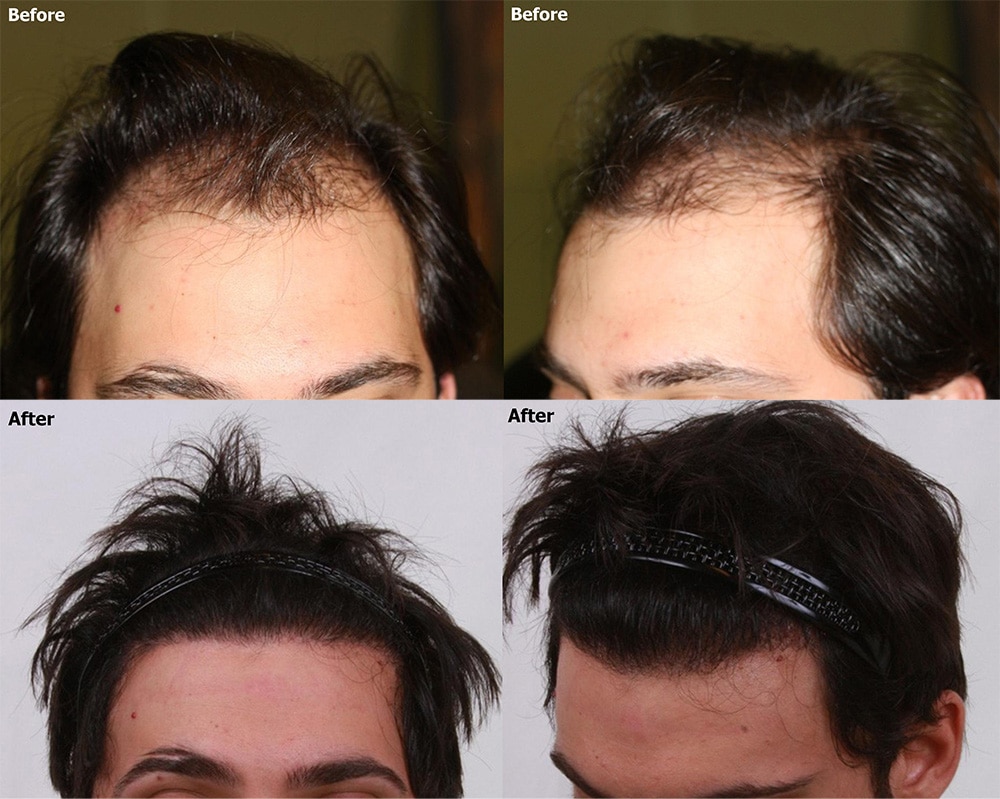 3,500 Grafts FUE Hair Transplant Result - AlviArmani - Hair Transplant Los  Angeles