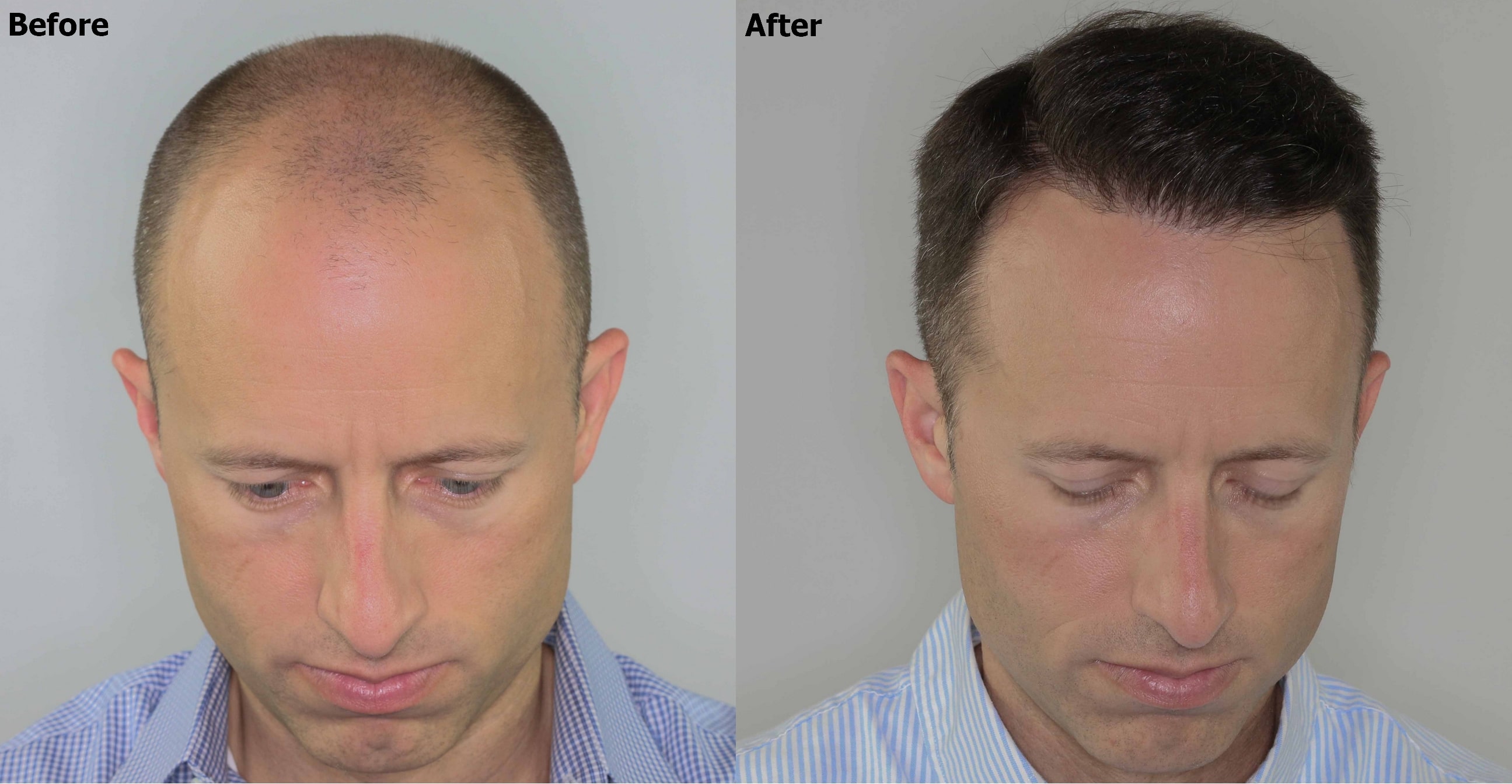 Norwood 5 hair transplant result - AlviArmani - Hair Transplant Los Angeles Norwood 5 hair transplant result - AlviArmani - Hair Transplant Los Angeles