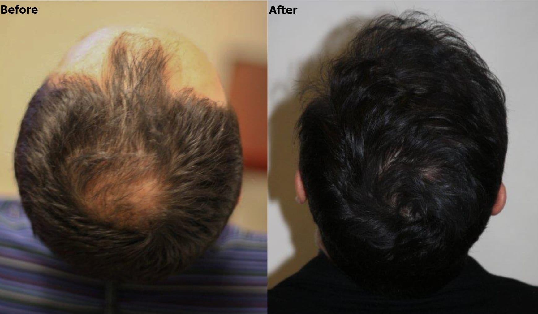 6,000 graft FUE - Full head of hair restored - AlviArmani - Hair Transplant  Los Angeles