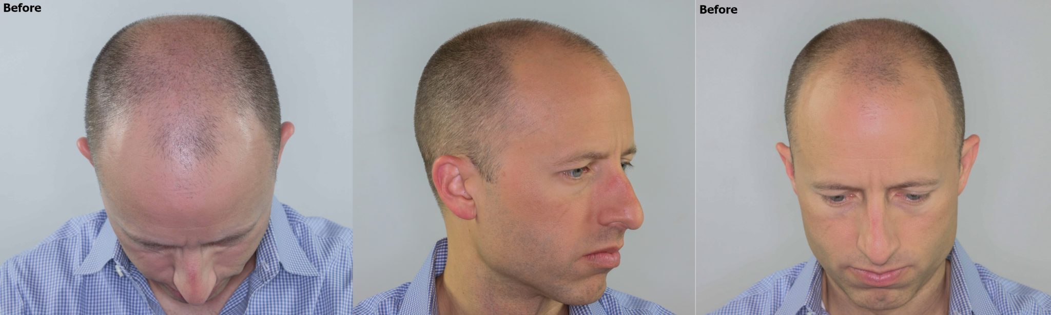 Norwood 5 hair transplant result AlviArmani Hair Transplant Los Angeles