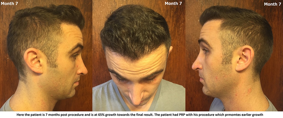 Hairline & Mid-scalp Restored With 1 FUE Session Of 3500 Grafts - AlviArmani - Hair Transplant Los Angeles Hairline & Mid-scalp Restored With 1 FUE Session Of 3500 Grafts - AlviArmani - Hair Transplant Los Angeles