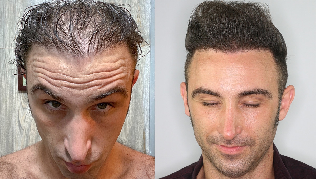 Hairline & Mid-scalp Restored With 1 FUE Session Of 3500 Grafts -  AlviArmani - Hair Transplant Los Angeles