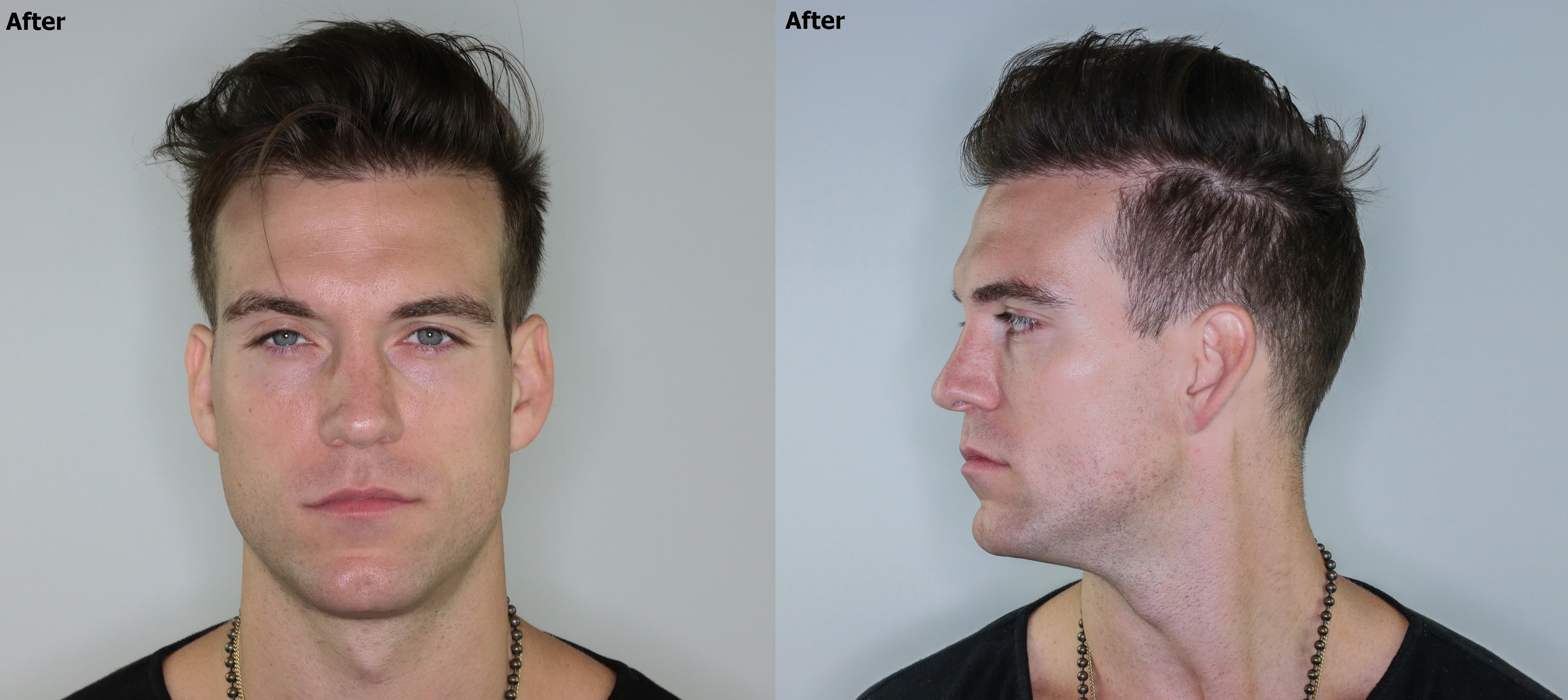 3,500 grafts FUE Hair Transplant - AlviArmani - Hair Transplant Los Angeles 3,500 grafts FUE Hair Transplant - AlviArmani - Hair Transplant Los Angeles
