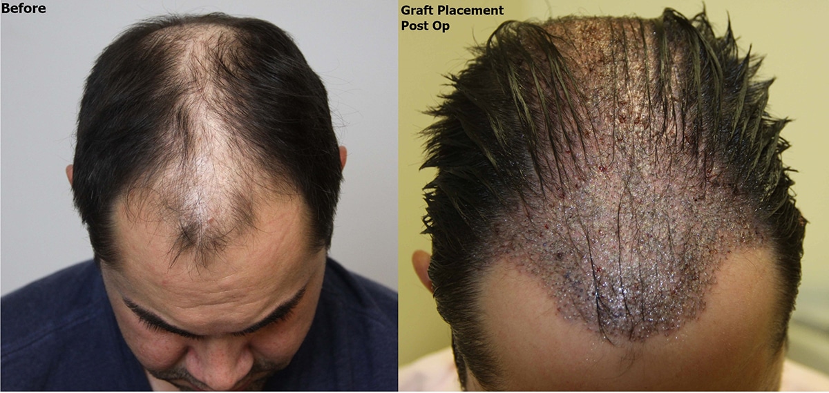FUE 6500 FUE Mega Session - AlviArmani - Hair Transplant Los Angeles FUE 6500 FUE Mega Session - AlviArmani - Hair Transplant Los Angeles
