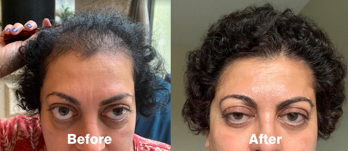Female Hair Restoration and Exosome result - AlviArmani - Hair Transplant  Los Angeles