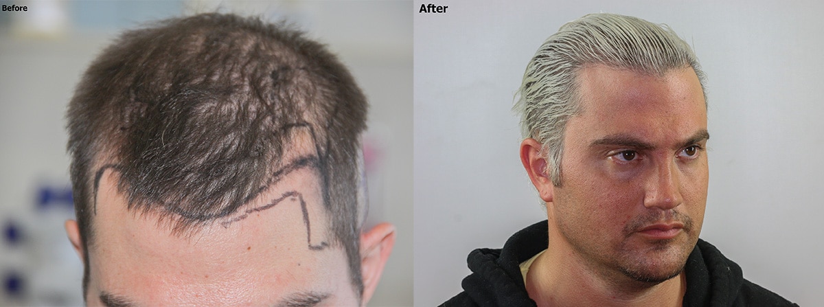 Temple closure hair restoration for facial framing - AlviArmani - Hair  Transplant Los Angeles
