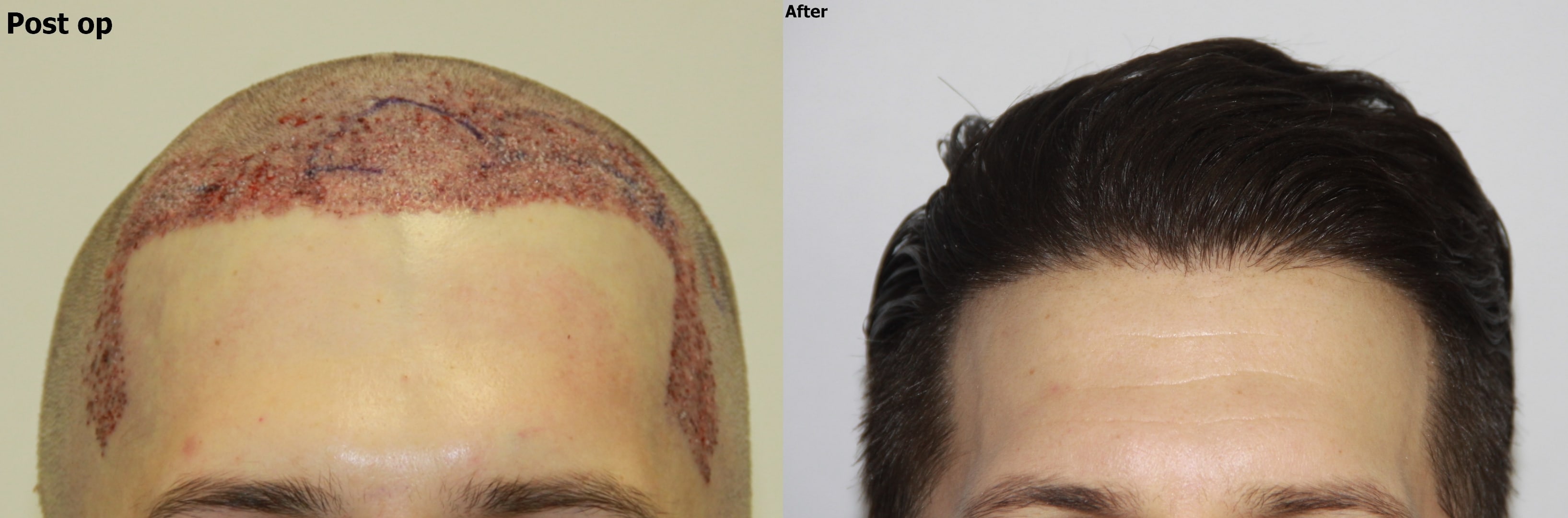 Diffuse Frontal Thinning FUE Hair Restoration - AlviArmani - Hair Transplant  Los Angeles