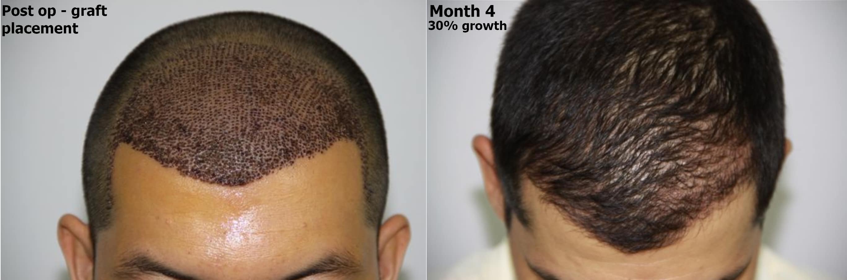 Hair Restoration Progression and Hair Growth Timeline - Alvi Armani