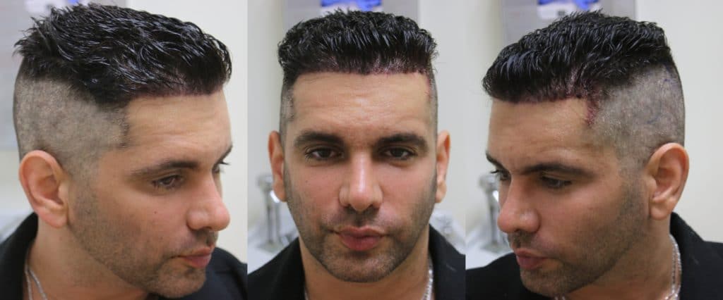 This patient had his hairline reinforced with our Non-shaving FUE technique. The photos are less than an hour after the procedure.
