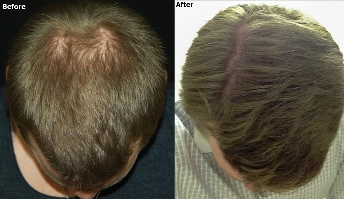 Exosomes Case Study for Hair Loss - AlviArmani Los angeles