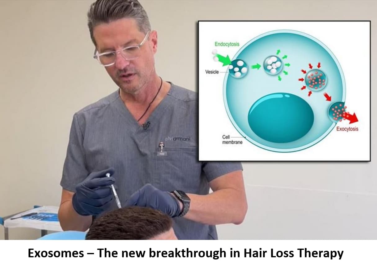 Exosome Hair Regrowth Treatment - AlviArmani - Hair Transplant Los Angeles