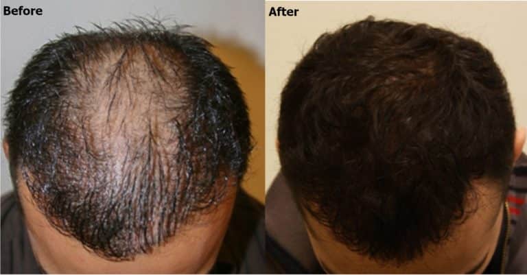 Hairline and crown combined zones