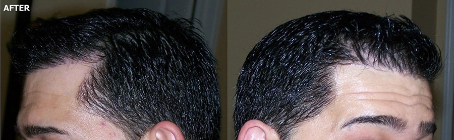 FUE Hairline Hair Restoration 2,970 Grafts - AlviArmani - Hair Transplant  Los Angeles
