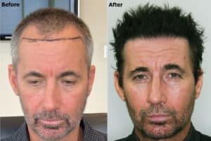 actor-hair-transplant