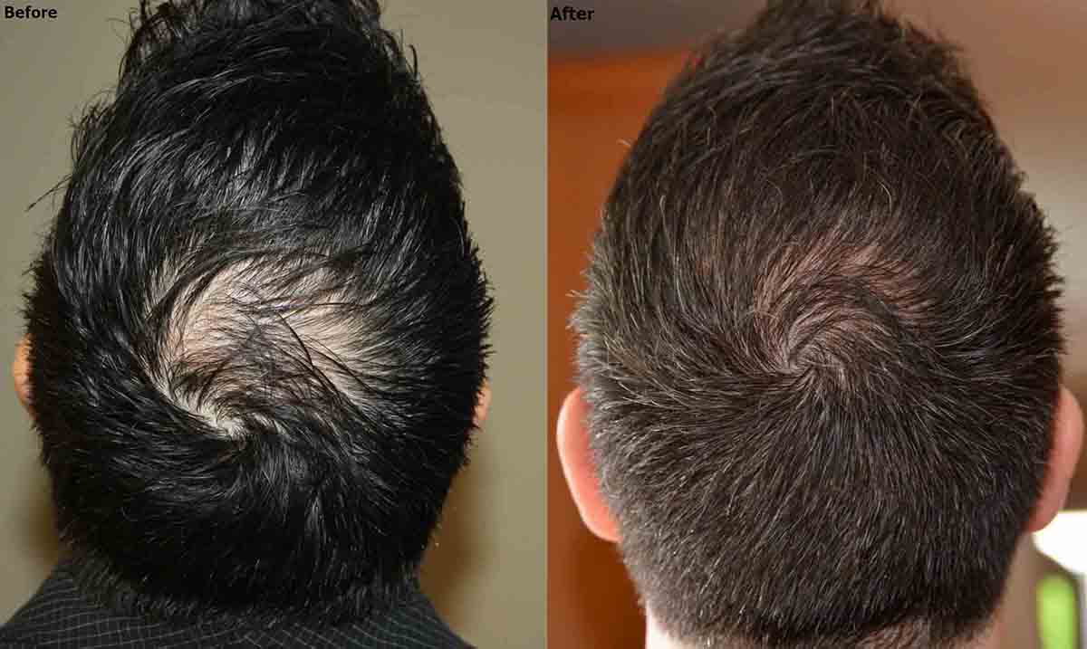 Exosome Hair Loss Treatment For The Crown - AlviArmani - Hair Transplant  Los Angeles