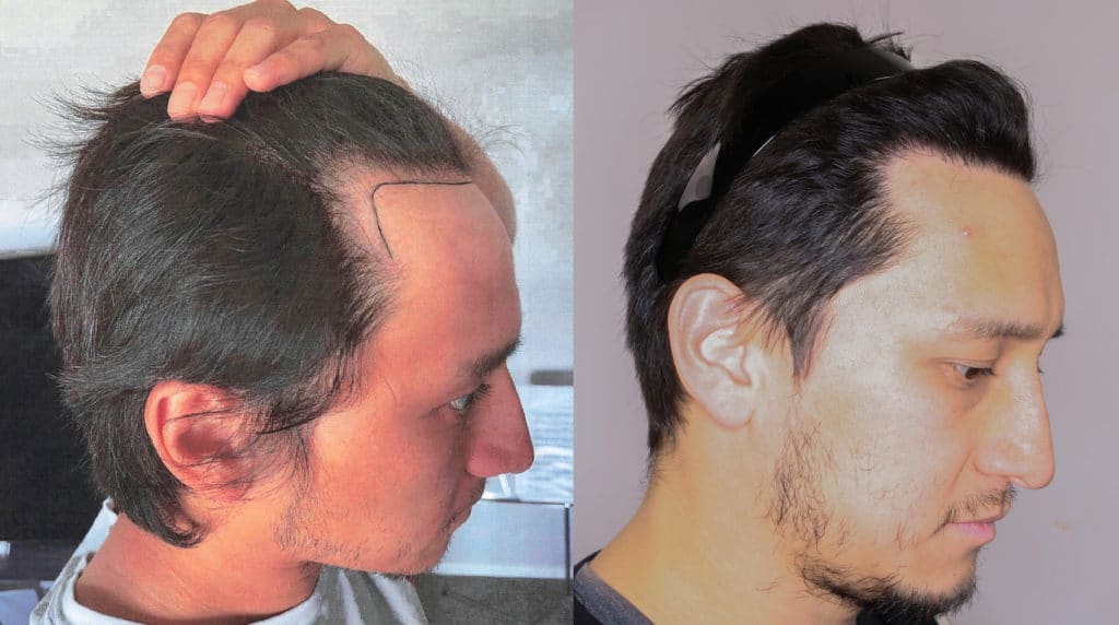 Before and 1 year after hairline restoration and natural temporal advancement.
