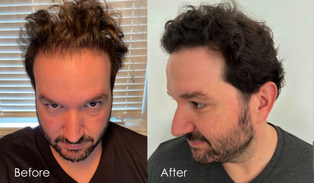 AlviArmani Review Before And After 3000 Graft FUE