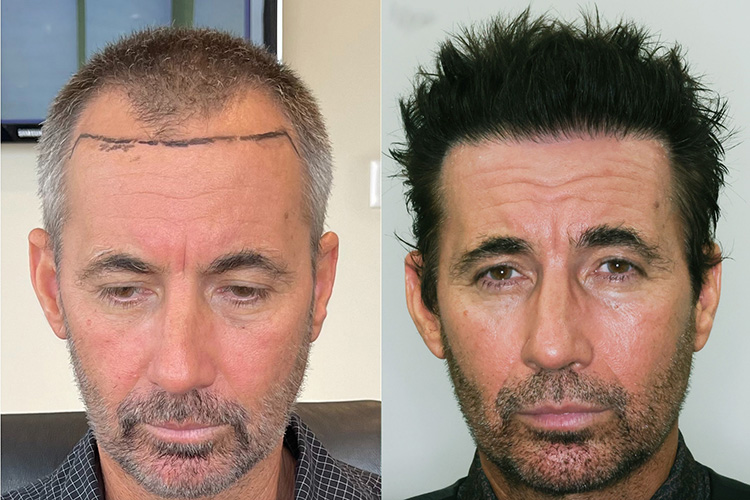 AlviArmani FUE hair transplant planning and restoration result