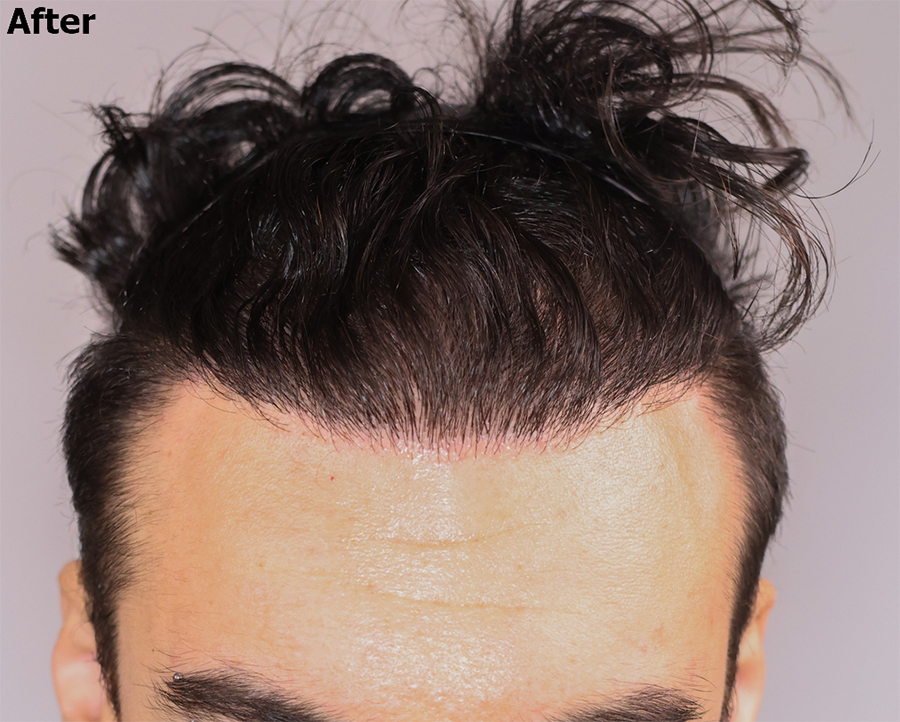 Natural looking hairline after hair transplant result