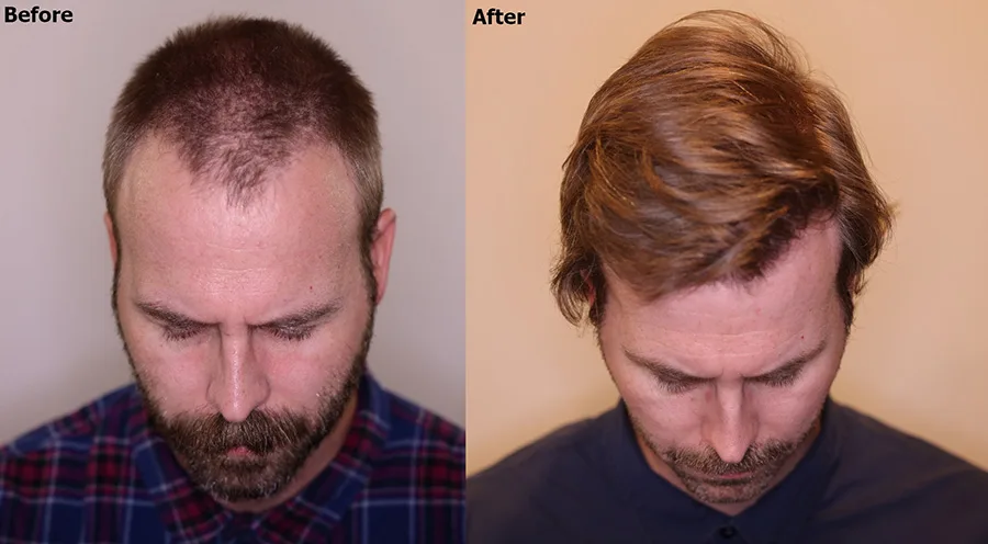 before and after 3,000 FUE Grafts