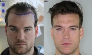 AlviArmani Before After FUE Hair Transplantation