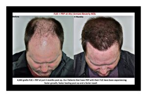 FUE Hair Transplant AlviArmani Before and After Hybrid Procedure