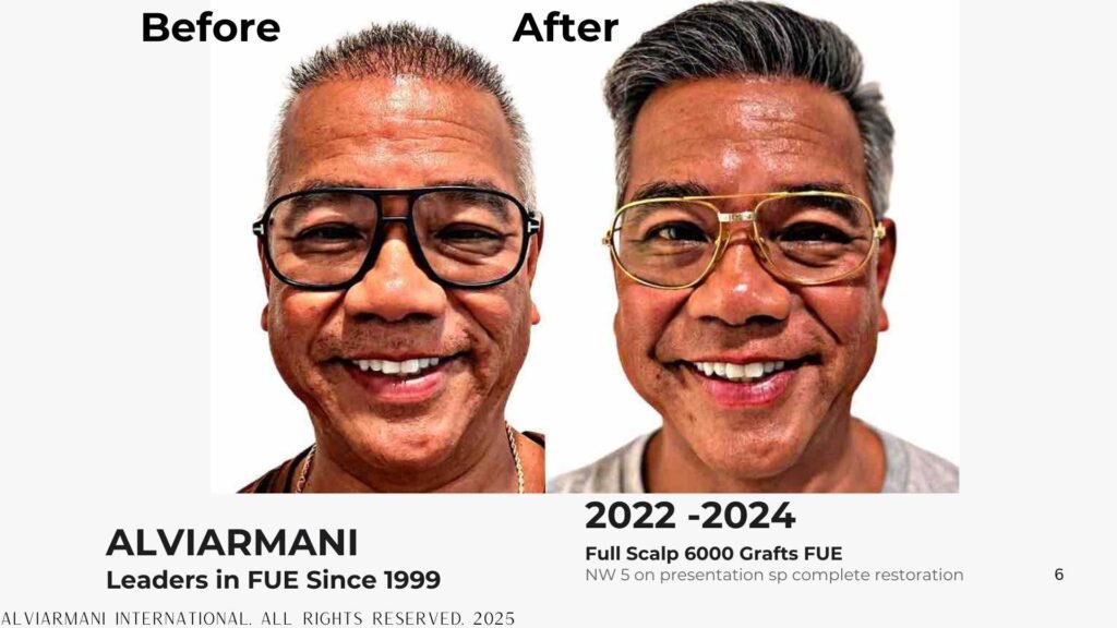 Before After Asian Hair Transplant Frontal