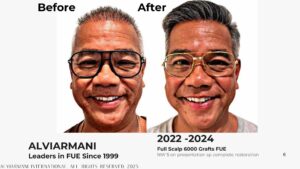 Before After Asian Hair Transplant Frontal